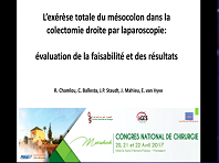 Exérèse totale du mésocolon dans la colectomie droite pour cancer