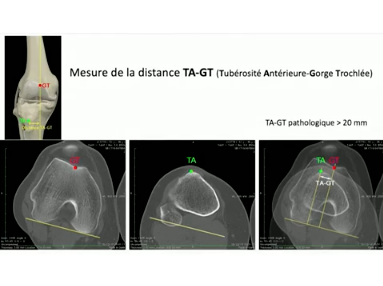 Examen clinique et imagerie actuelle de linstabilité fémoro-patellaire Examen clinique et imagerie actuelle de linstabilité fémoro-patellaire