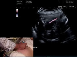 Examen de l'appareil urinaire foetal : démonstration Examen de l'appareil urinaire foetal : démonstration