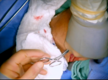 Excision of an Infected Arteriovenous Graft Excision of an Infected Arteriovenous Graft