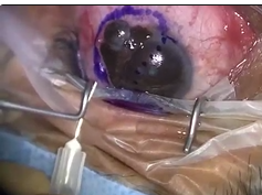 Excisional Biopsy of Pigmented Conjunctival Lesion Excisional Biopsy of Pigmented Conjunctival Lesion