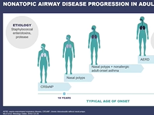 Exploring Type 2 Inflammation in Nasal Polyps and Beyond
