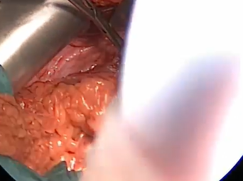 Exposing Left Iliac Artery for a Distal Anastomosis: Aortoiliac Bypass (Alan B. Lumsden, MD) Exposing Left Iliac Artery for a Distal Anastomosis: Aortoiliac Bypass (Alan B. Lumsden, MD)