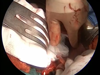 Exposing Right Iliac Artery for a Distal Anastomosis: Aortoiliac Bypass (Alan B. Lumsden, MD) Exposing Right Iliac Artery for a Distal Anastomosis: Aortoiliac Bypass (Alan B. Lumsden, MD)