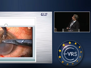 Expulsive Hemorrhage During Penetrating Keratoplasty