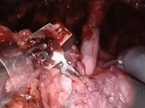 Extended Prostatic Urethral Preservation (EPUP) during Robotic Radical Prostatectomy Extended Prostatic Urethral Preservation (EPUP) during Robotic Radical Prostatectomy