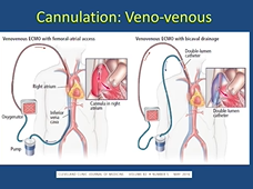Extracorporeal Life Support in Advanced Lung Disease