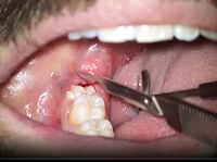 Extraction Without Forceps (E.W.F.)