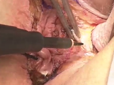 Extralevator Abdominoperineal Resection.