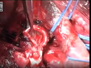 Extrapericardial pneumonectomy Extrapericardial pneumonectomy