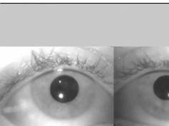 Eye Movements in Germ Cell Tumor Encephalitis Eye Movements in Germ Cell Tumor Encephalitis