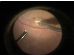 Eye Parasite Removal Eye Parasite Removal