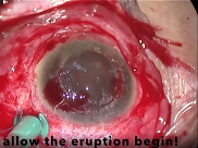 Eye Reconstruction No Limit by Barbara Parolini