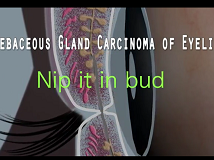 Eyelid Sebaceous Gland Carcinoma: Nip in the bud! Eyelid Sebaceous Gland Carcinoma: Nip in the bud!