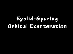 Eyelid-Sparing Orbital Exenteration Eyelid-Sparing Orbital Exenteration