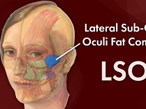 Face the Fats. Plastic Surgery Hot Topics with Rod J. Rohrich, MD