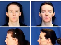 Facial Feminization Surgery & Quality of Life. Plastic Surgery Hot Topics with Rod J. Rohrich, MD Facial Feminization Surgery & Quality of Life. Plastic Surgery Hot Topics with Rod J. Rohrich, MD