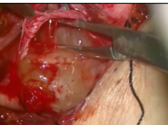 Facial Nerve Function Preservation During Schwannoma Surgery Using EMG