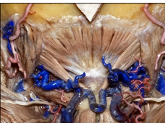 Far Lateral Approach and Jugular Foramen (3D) - Part 1 of 2
