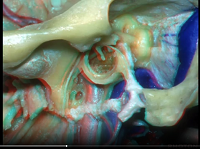 Far Lateral Approach and Jugular Foramen (3D) - Part 2 of 2 Far Lateral Approach and Jugular Foramen (3D) - Part 2 of 2