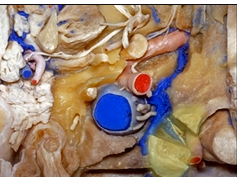Far Lateral Approach and Jugular Foramen (3D) - Part 2 of 2