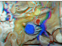 Far Lateral Approach and Jugular Foramen - Part 2 of 2