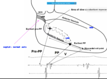 Fascicular VT - Approach to ablation with basics