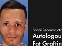 Fat Fights Facial Asymmetry. Plastic Surgery Hot Topics with Rod J. Rohrich, MD Fat Fights Facial Asymmetry. Plastic Surgery Hot Topics with Rod J. Rohrich, MD