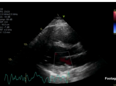 Fatal Giant Cell Myocarditis