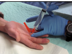 felon drainage - abscess of the pulp of a finger