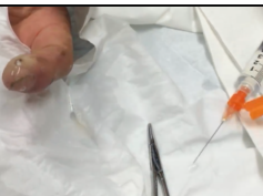 FELON - Large abscess of the pulp of the finger