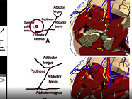 Femoral and obturator nerve block