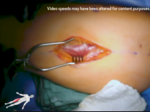 Femoral Vein Harvest Femoral Vein Harvest