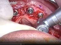 Fence Technique: implant insertion