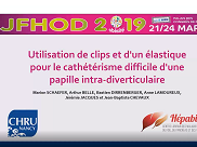 Fermeture endoscopique d'une fistule rectale sur maladie de Crohn