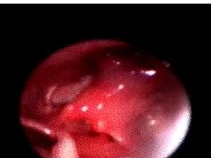 Fiber-optic Laryngoscopic View of a Large Bilobed Cushion With Blue Coloration in a 1-Month-Old Infa Fiber-optic Laryngoscopic View of a Large Bilobed Cushion With Blue Coloration in a 1-Month-Old Infa