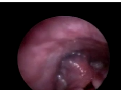 Fiber-optic Laryngoscopic View of a Large Cushion With Blue Coloration in a 1-Month-Old Infant Who I Fiber-optic Laryngoscopic View of a Large Cushion With Blue Coloration in a 1-Month-Old Infant Who I
