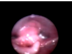 Fiber-optic Laryngoscopic View of a Large Cushion With No Vascular Coloration in a 3-Month-Old Infan Fiber-optic Laryngoscopic View of a Large Cushion With No Vascular Coloration in a 3-Month-Old Infan