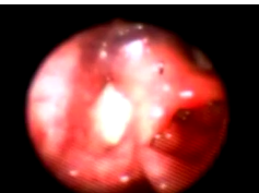 Fiber-optic Laryngoscopic View of a Large Violaceous Cushion in a 10-Month-Old Infant Who Is Crying