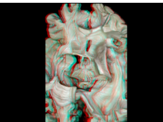 Fiber Pathways of the Cerebrum (3D Anaglyph)