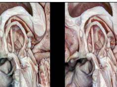 Fiber Pathways of the Cerebrum (3D TV)