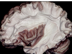 Fiber Pathways of the Cerebrum