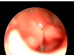 Fiberoptic Laryngoscopy of Child's Larynx