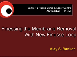 Finessing Membrane Removal With New Finesse Loop Finessing Membrane Removal With New Finesse Loop