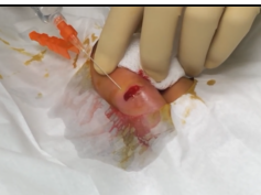 finger abscess and cellulitis