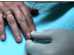 Finger infection Drainage Procedure