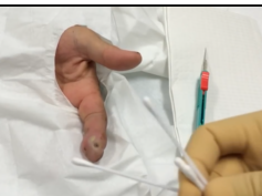 finger pulp abscess drainage EXPLOSION of pus - watch to the end for patient POEM finger pulp abscess drainage EXPLOSION of pus - watch to the end for patient POEM