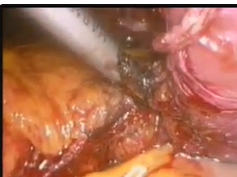 First Report Of A Paraganglioma Of The Angle Of Treitz?