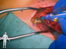 First Rib Resection Using an Infraclavicular Anterior Approach First Rib Resection Using an Infraclavicular Anterior Approach