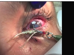Fishhook in the Eye - Removal and Treatment Fishhook in the Eye - Removal and Treatment